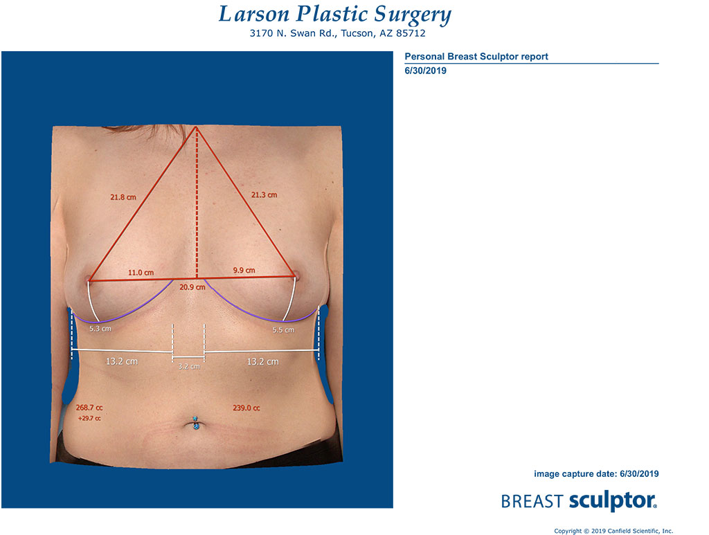 Vectra 3D Imaging  Larson Plastic Surgery