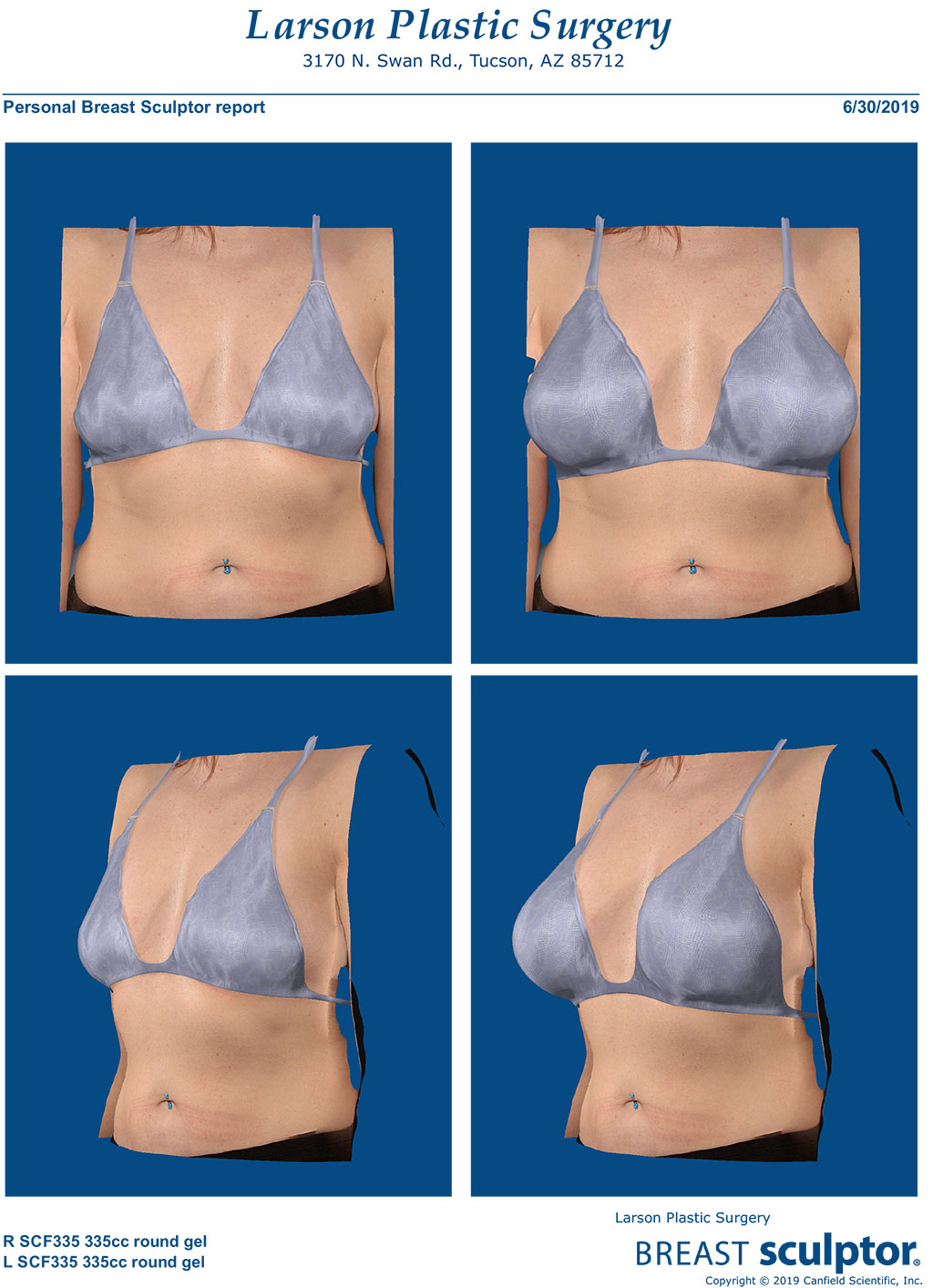 Visualize Your Breast Augmentation Results with Vectra 3D- Bay